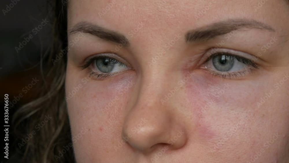 Young girl with an allergic reaction on the face and eyes, Quincke's edema. Swelling of the face from nose to eyes in a young woman. Angioedema close up view