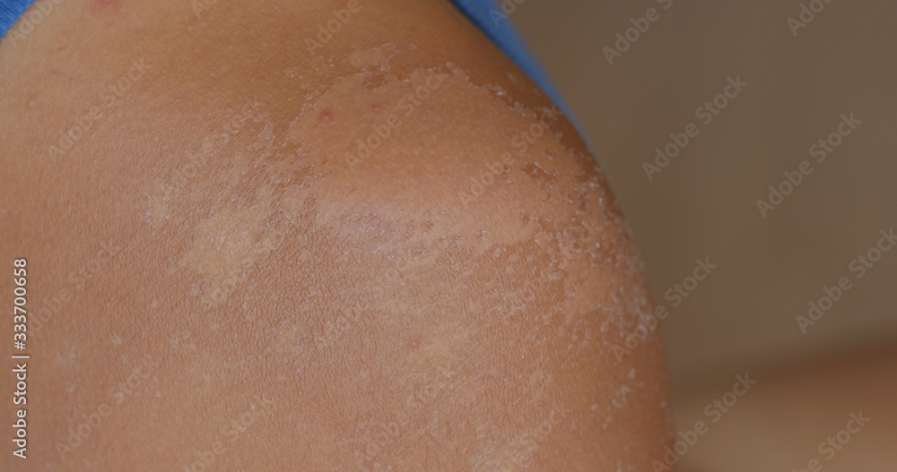 Fototapeta premium Sunburned skin, peeling skin from a sunburn