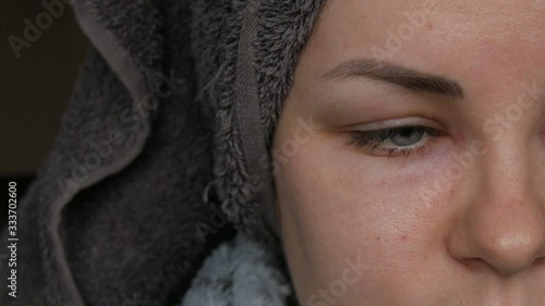 Young girl with an allergic reaction on the face and eyes, Quincke's edema. Swelling of the face from nose to eyes in a young woman. Angioedema, Swollen face girl with a bath towel on her head. photo