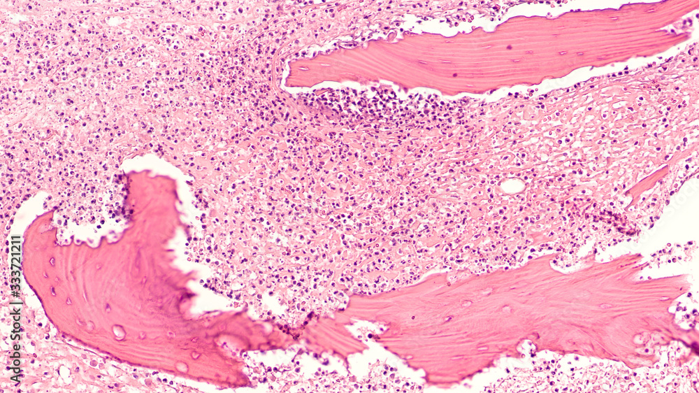 Diabetes Awareness Photomicrograph showing osteomyelitis, with