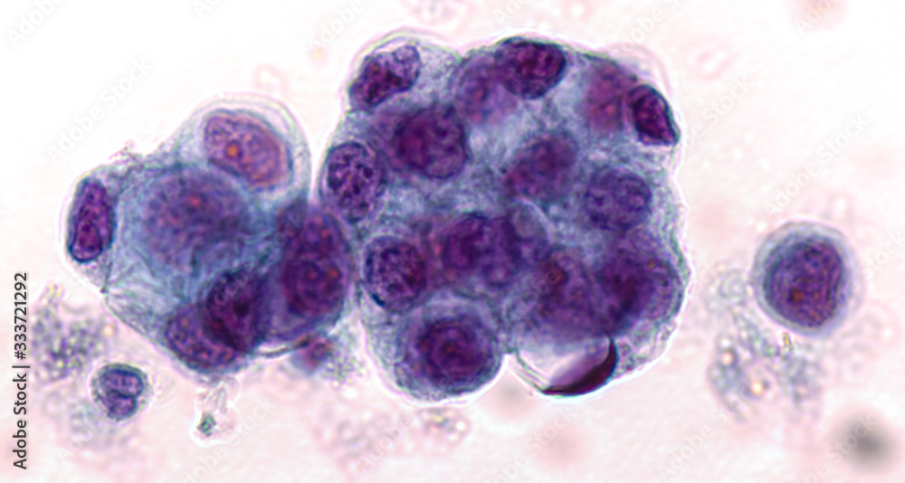Malignant fluid cytology; Malignant cells of adenocarcinoma may spread