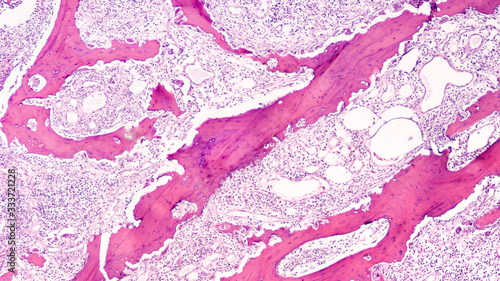 Diabetes Awareness: Photomicrograph showing osteomyelitis, with necrotic (dead) bone and inflammation, from amputation of big toe of a patient with uncontrolled diabetes mellitus.   photo