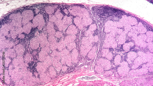 Sarcoidosis Awareness: Micrograph of an enlarged lymph node showing non-caseating granulomas of sarcoidosis.  The exact cause of sarcoidosis is not known, but it may be a type of autoimmune disease.  photo