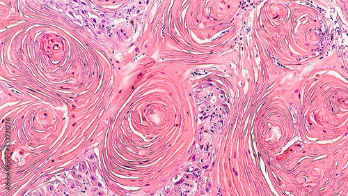 Microscopic image of skin biopsy of invasive squamous cell carcinoma, well differentiated, with prominent squamous pearls.  Regular use of sunscreen can be preventative.