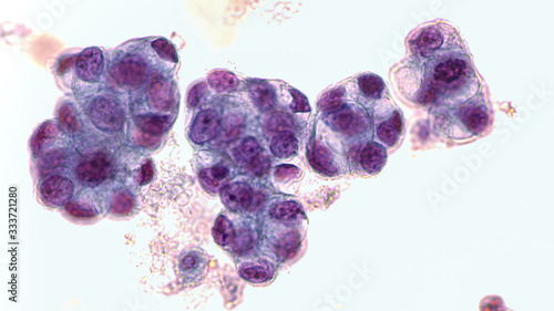 Malignant fluid cytology;   Malignant cells of adenocarcinoma may spread to fluid of  pleural or peritoneal cavity in cancer from the breast,  lung, colon, pancreas, ovary, endometrium or other sites. photo