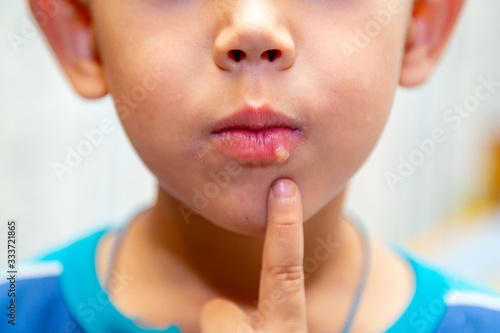 herpes on the lower lip of the kid photo