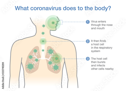 Medical diagram for explain about what coronavirus does to the body. Illustration about Covid-19 disease when virus into respiratory system.