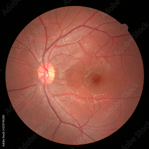 Retinal picture ,Medical photo tractional (eye screen) retinal detachment of diabetes. isolated on black background. photo