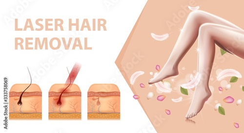 Feminine Hairless Smooth Legs, Petals, Feathers and Aid with Cross Section of Human Skin and Damaged Follicle, Steps of Laser Hair Removal Procedure 3D Vector Realistic Illustration, Horizontal Banner