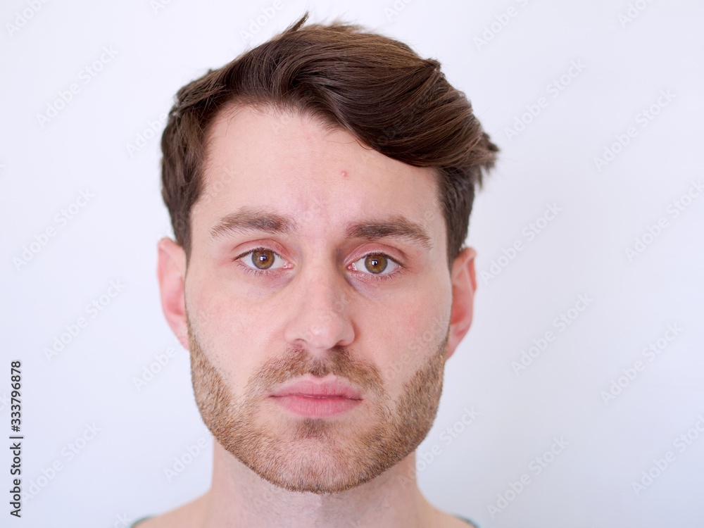 Obraz premium Closeup of a young caucasian man with a pimple on his forehead.