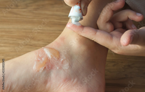 blisters on a child's foot from scalding