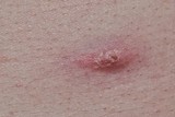 Acne pimple on Caucasian skin beginning to scab and heal over. Macro image of infection and healing process. Health and medical problems.