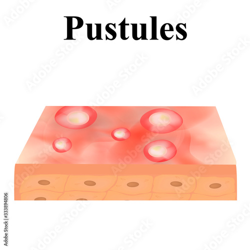 Pustules. Acne on the skin. Dermatological and cosmetic diseases on the skin of the face acne. Infographics. Vector illustration on isolated background.