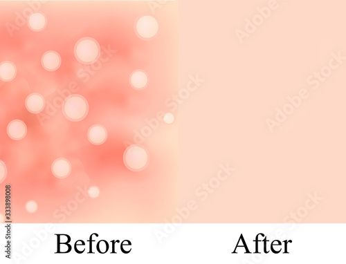 Texture, inflamed pimples and acne. Before After acne. Skin background. Infographics. Vector illustration on isolated background