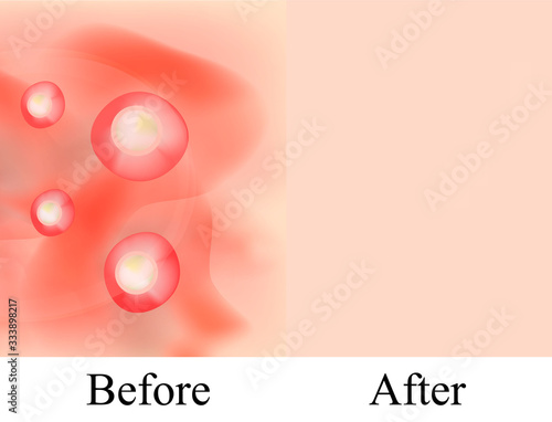 Texture, inflamed pimples and acne. Before After acne cysts. Skin background. Infographics. Vector illustration on isolated background.