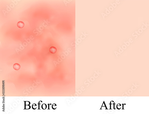 Texture, inflamed pimples and acne. Before After acne cysts. Skin background. Infographics. Vector illustration on isolated background.