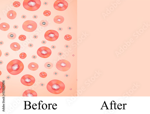 Texture, inflamed pimples and acne. Before After acne cysts. Skin background. Infographics. Vector illustration on isolated background.