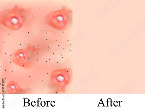 Texture, inflamed pimples and acne. Before After acne cysts. Skin background. Infographics. Vector illustration on isolated background.