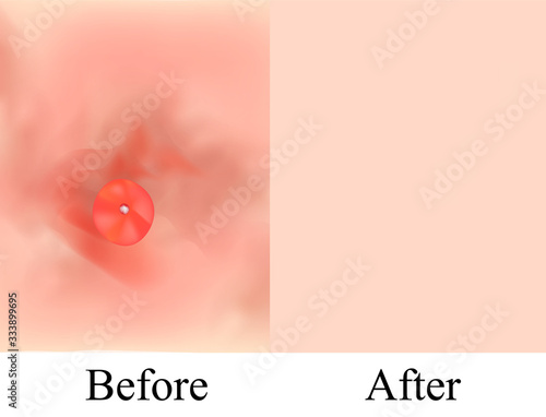 Texture, inflamed pimples and acne. Before After acne cysts. Skin background. Infographics. Vector illustration on isolated background.
