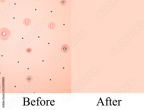 Texture, inflamed pimples and acne. Before After acne. Skin background. Infographics. Vector illustration on isolated background