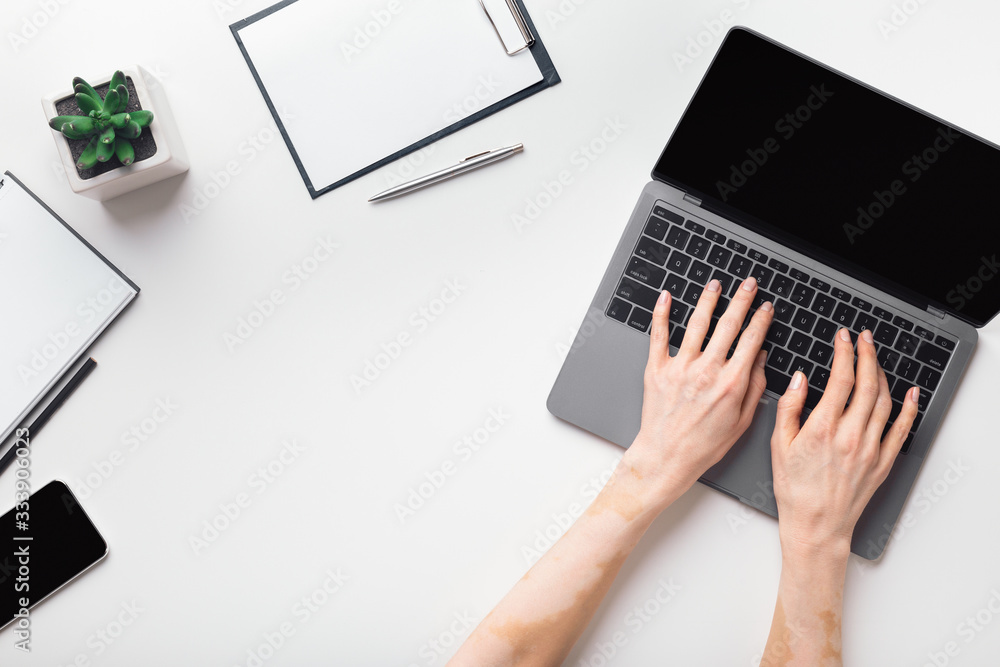 Female hands with vitiligo working on modern laptop Female hands with vitiligo working on modern laptop
