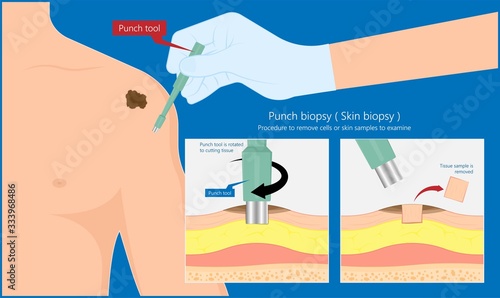 Skin biopsy dermoscope tool surgical diagnose lupus rash cell exam medical Shave Punch dermis layer superficial fat ABCDE rule sign check basal moles treat remove inflammatory tags Warts lab test type