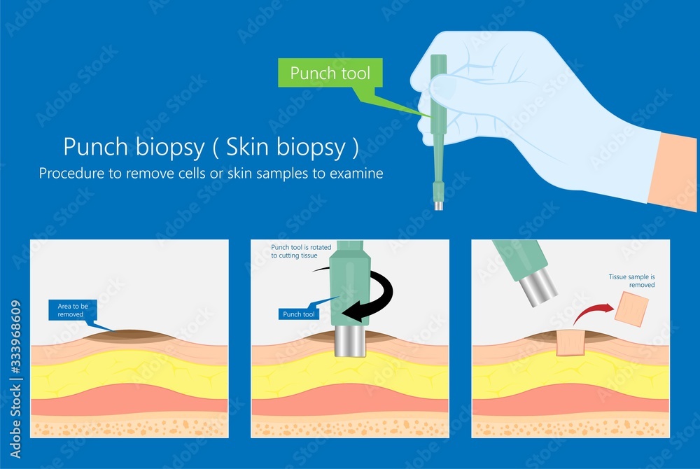 Skin biopsy dermoscope tool surgical diagnose lupus rash cell exam