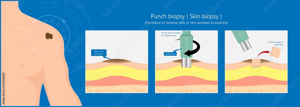 Skin biopsy dermoscope tool surgical diagnose lupus rash cell exam medical Shave Punch dermis layer superficial fat ABCDE rule sign check basal moles treat remove inflammatory tags Warts lab test type Skin biopsy dermoscope tool surgical diagnose lupus rash cell exam medical Shave Punch dermis layer superficial fat ABCDE rule sign check basal moles treat remove inflammatory tags Warts lab test type