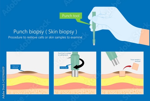 Skin biopsy dermoscope tool surgical diagnose lupus rash cell exam medical Shave Punch dermis layer superficial fat ABCDE rule sign check basal moles treat remove inflammatory tags Warts lab test type