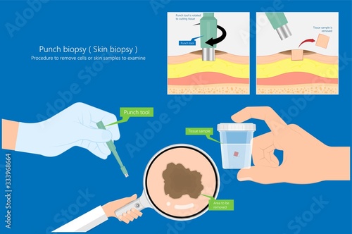 Skin biopsy dermoscope tool surgical diagnose lupus rash cell exam medical Shave Punch dermis layer superficial fat ABCDE rule sign check basal moles treat remove inflammatory tags Warts lab test type