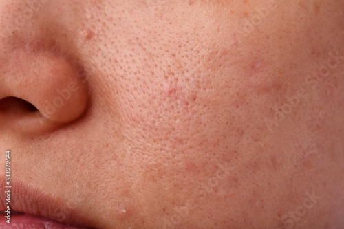 Skin problem with acne diseases, Close up woman face with dry lip mouth, Scar and oily greasy face, Beauty concept.