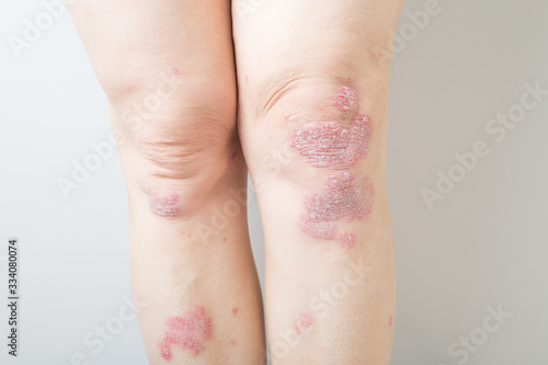 Acute psoriasis on the knees is an autoimmune incurable dermatological skin disease. Large red, inflamed, flaky rash on the knees. Joints affected by psoriatic arthritis.Close up