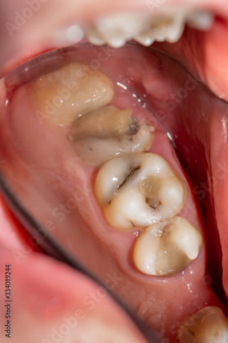 treatment of tooth decay with subsequent filling with photopolymer material. Close-up, macro