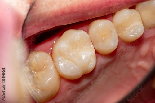 treatment of tooth decay with subsequent filling with photopolymer material. Close-up, macro