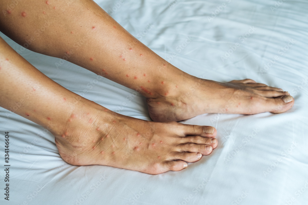Female legs with many red spot and scar from sand fly bites Stock Photo