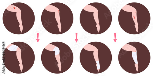 Wounds treatment and bandage application infographics. First aid