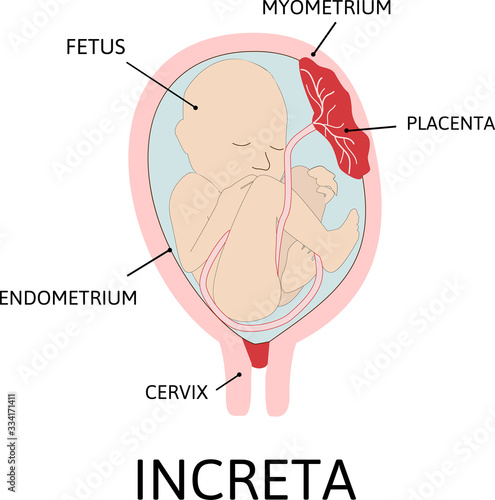 Placenta increta. grades of abnormal attachment illustrated according to the depth