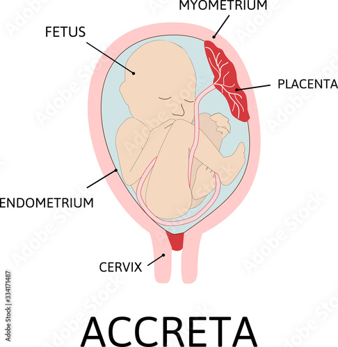 Placenta accreta. grades of abnormal attachment illustrated according to the depth