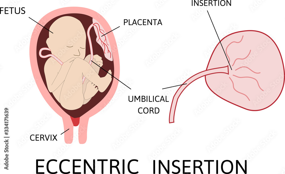 Vecteur Stock Eccentric Insertion Of Umbilical Cord Insertion Site   1000 F 334171639 IoXZuTWlUX9DvnrxjYMceJ6xBwo8K1nS 