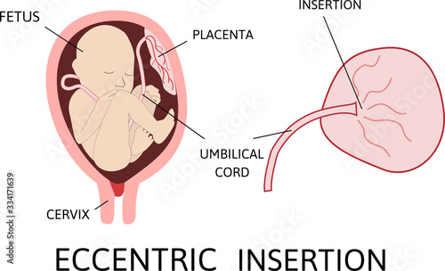Eccentric insertion of umbilical cord. insertion site varies from the center of the fetal surface to the border of the placenta.