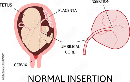 Normal insertion of umbilical cord.  Medical vector illustration