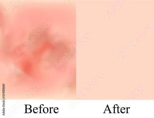 Texture, inflamed pimples and acne. Before After acne cysts. Skin background. Infographics. Vector illustration on isolated background.