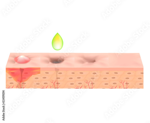 Atrophic scars. Acne scar. The anatomical structure of the skin with acne. Vector illustration on isolated background.