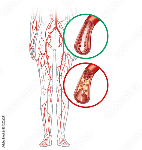 Peripheral artery occlusive disease, intermittent claudication, medical illustration
