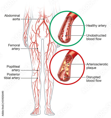 Peripheral artery occlusive disease, intermittent claudication, medical illustration photo