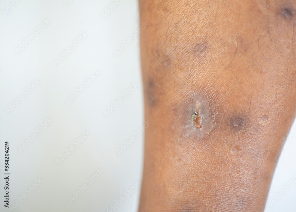 Naklejka premium Wounds that may be infected