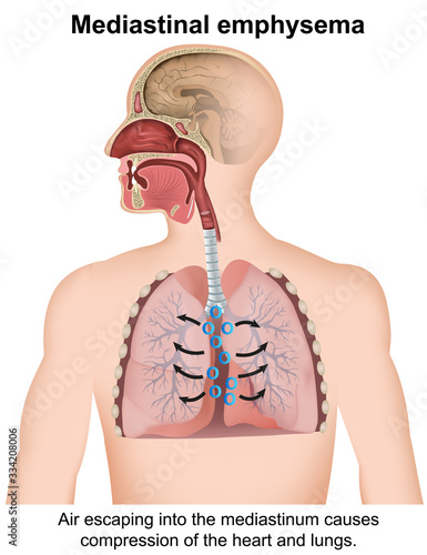 mediastinal emphysema medical vector illustration isolated on white background