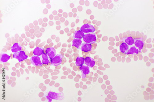 Acute promyelocytic leukemia cells or APL  analyze by microscope  original magnification 1000x