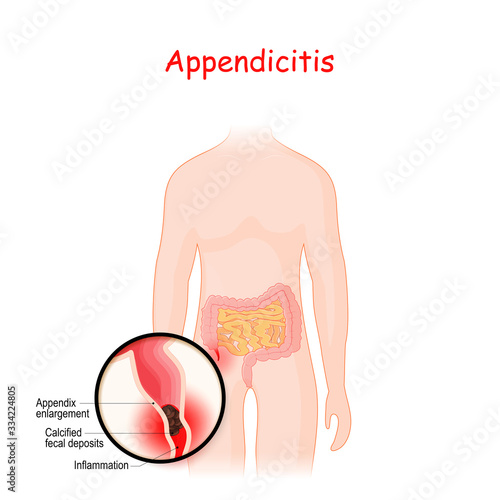 Appendicitis. closeup of appendix with Inflammation.