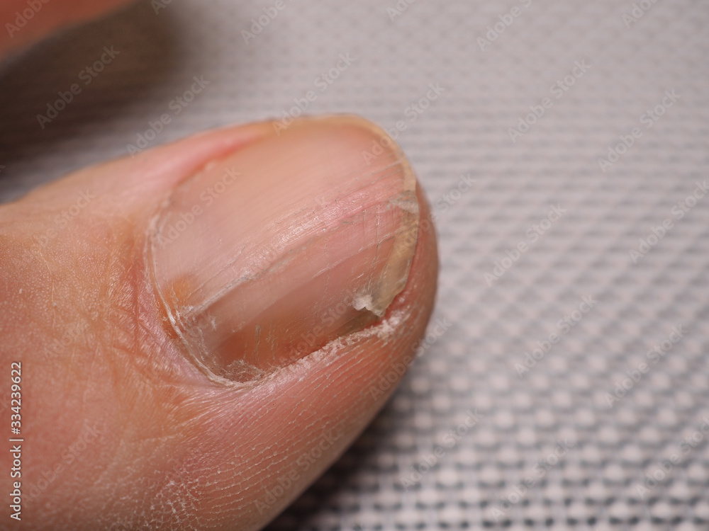 Nail infections caused by fungi such as: onychomycosis caused by dermatophytes and yeasts and for the concomitant antibacterial activity Nail infections caused by fungi such as: onychomycosis caused by dermatophytes and yeasts and for the concomitant antibacterial activity